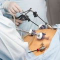 What are the Steps for Gastric Bypass Surgery?