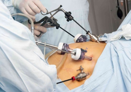 What are the Steps for Gastric Bypass Surgery?